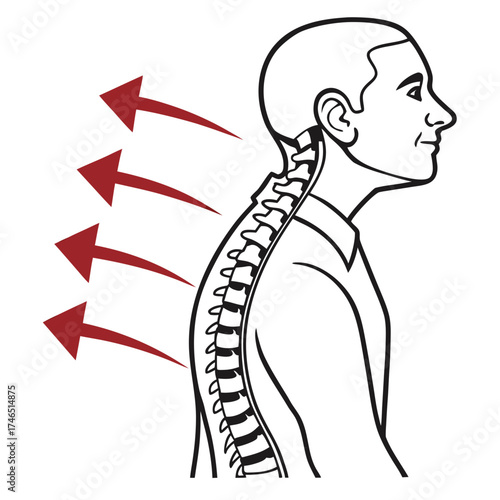 Diagram illustrating the human spine and neck with red arrows indicating pressure or force applied to the back of the neck and upper spine