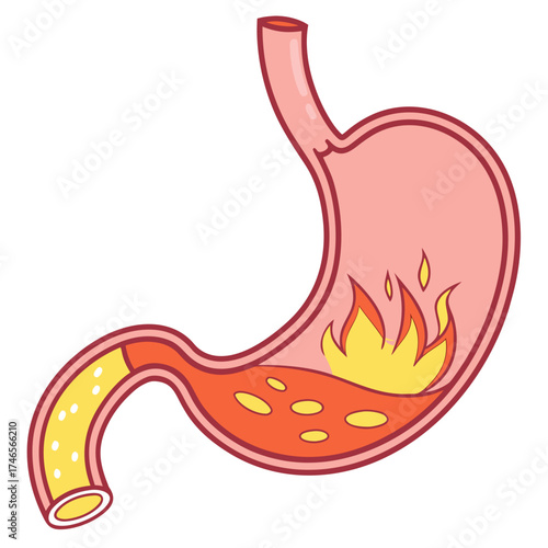 Cartoon stomach illustration showing heartburn with flames and acid representing digestive health issues and discomfort for medical and educational use