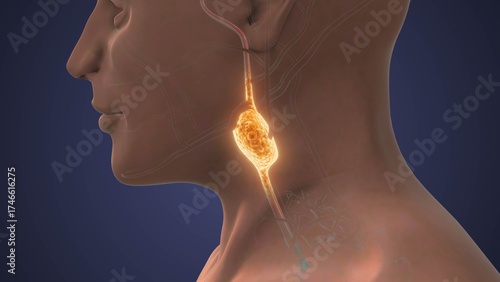 Paraganglioma Tumor Rare Neuroendocrine Growth in Human Body