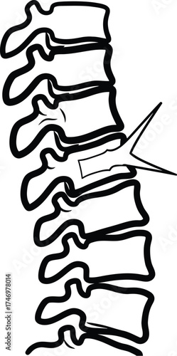 A simplified line drawing of a human lumbar spine showing a herniated disc pressing on a nerve root.