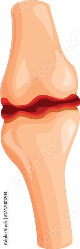 Medical illustration depicting joint inflammation, highlighting the painful condition of arthritis, causing discomfort and mobility issues