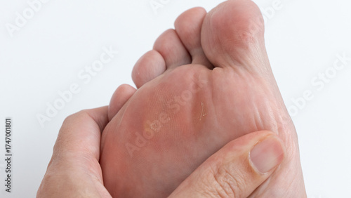 Close-up of a hand gently pressing on a foot with corns and calluses, highlighting foot health and care in a clean, bright environment
