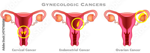 Gynecologic cancers. Endometrial, ovarian, cervical illness. Woman, female reproductive system disease. Vector illustration