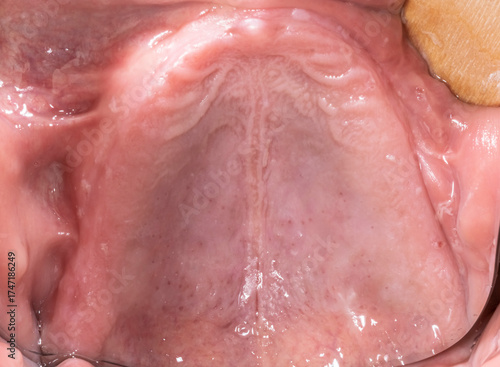 Close-up intraoral mirror view from below showing an edentulous and atrophied maxillary arch in an elderly patient, with lips and cheeks retracted using a wooden tongue depressor.