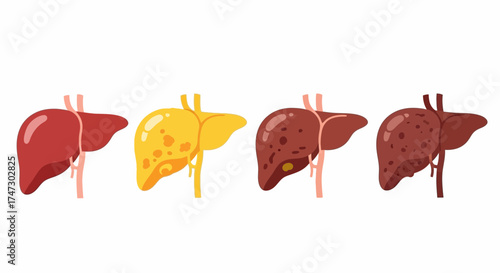 Illustration showing the progression of liver disease, from a healthy liver to one with severe damage and cirrhosis.
