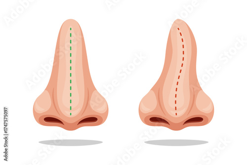 Illustration curve and correct nose, correction nasal curvature. Nose before and after.