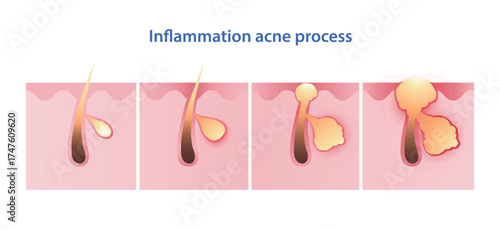 Inflammation acne process vector illustration isolated on white background. From micro inflammation to visible inflammatory acne, papule, pustule, blister or pimple on the skin inflamed, contain pus.