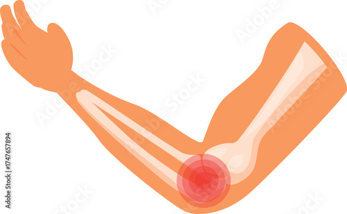 Cartoon illustration of a human arm with bones and painful elbow joint