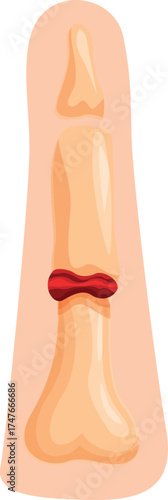 Finger fracture showing broken phalanx bone with red swelling and bruising, medical illustration