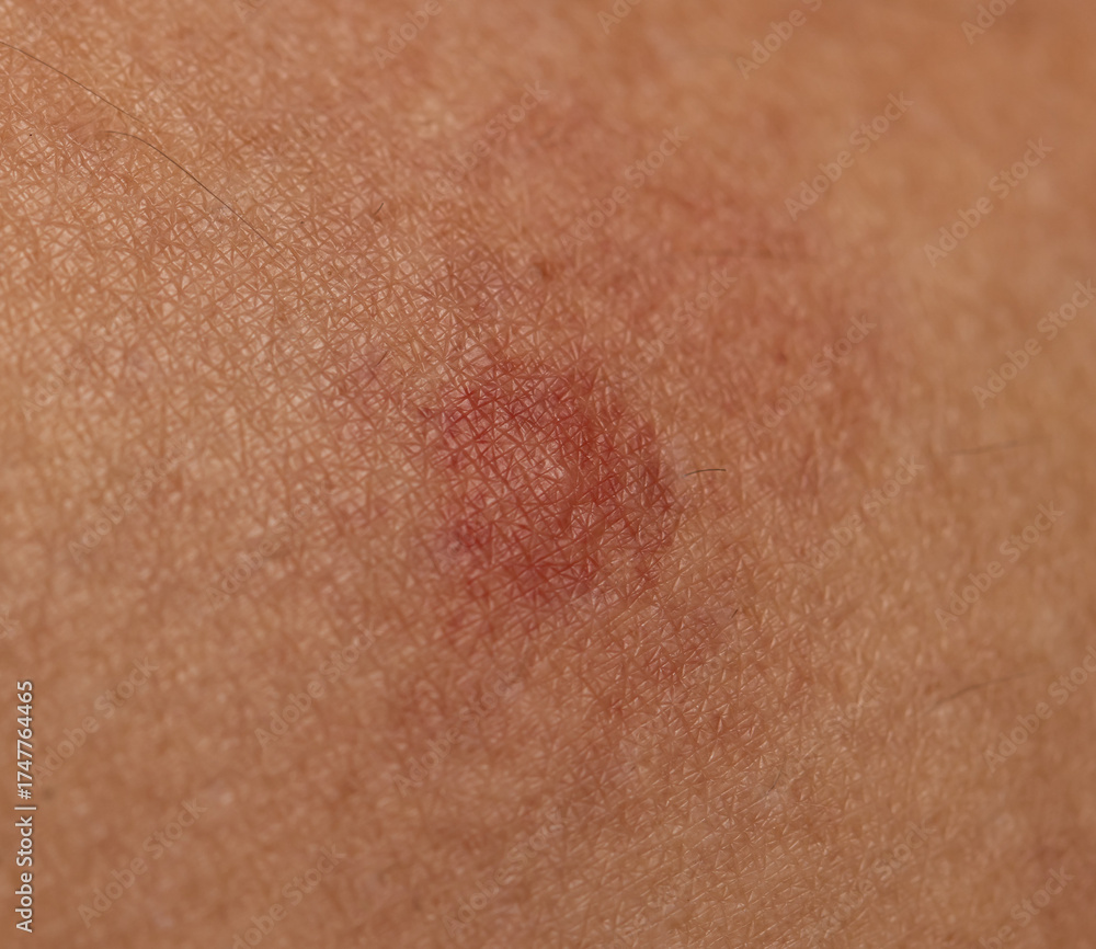 Fototapeta premium A red mark on a person's arm
