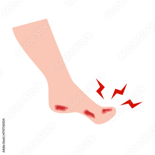Athlete's Foot disease concept