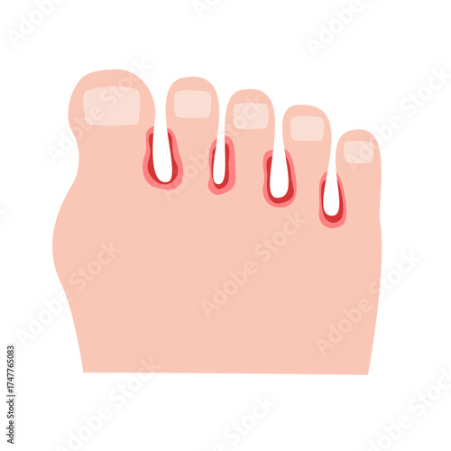 Athlete's Foot disease concept