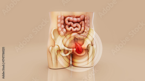 Conceptual 3D illustration of a human hernia