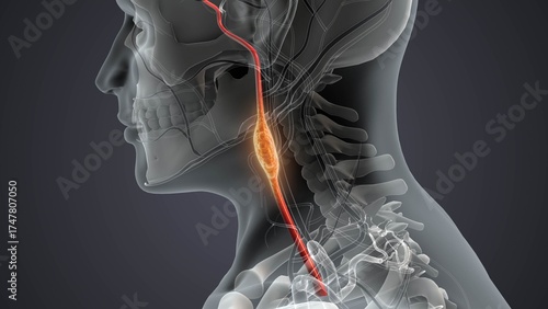 Obraz na płótnie Neuroendocrine Paraganglioma Tumor in Humans