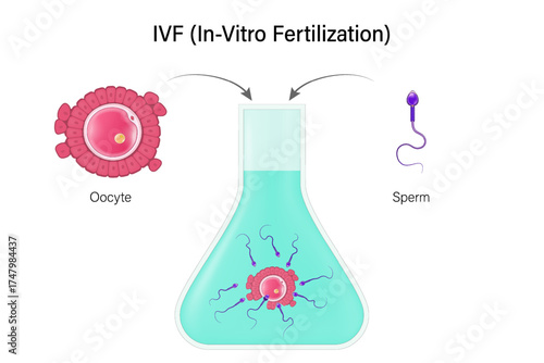 IVF. In-Vitro Fertilization. Fertility treatment. Assisted reproductive technology in fertility treatment. Oocyte and Sperm.