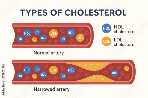 Types of cholesterol: hdl and ldl in artery health