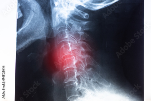 Side X-ray scan with displacement of intervertebral discs and herniation in the cervical spine.