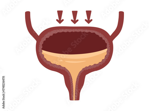 Bladder Stress Incontinence
