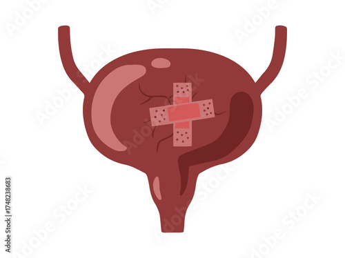 Bladder Disease Illustration