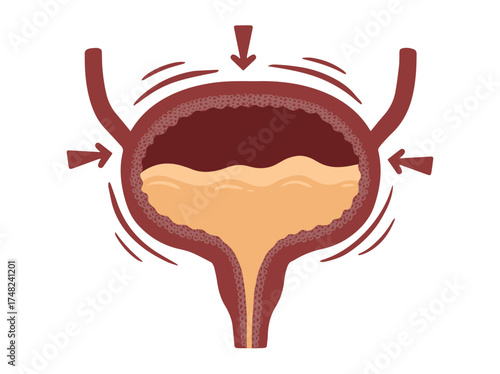 Bladder Incontinence Overactive Illustration