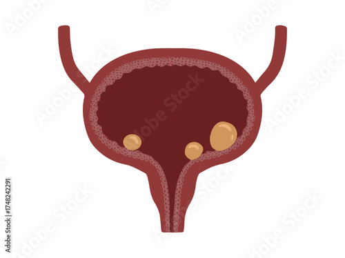 Bladder Stones Illustration