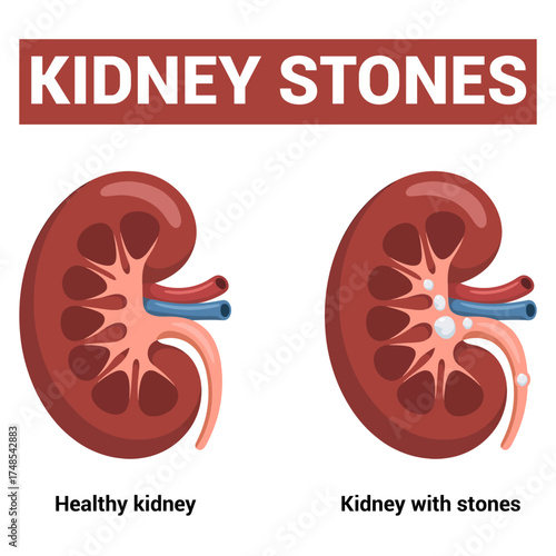 Diagram showing kidney stones vector