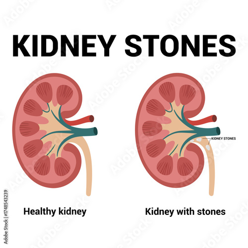 Diagram showing kidney stones vector