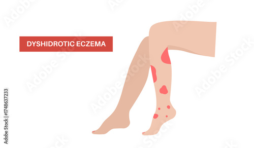Dermatitis skin disease