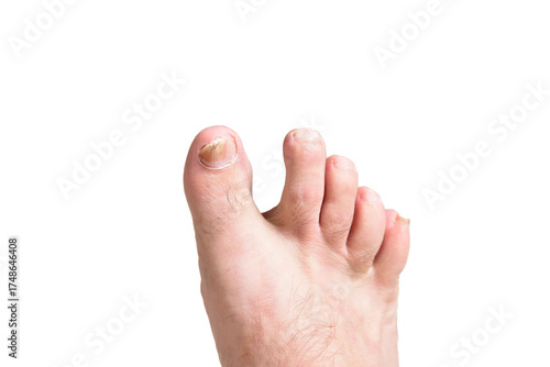 mycosis Fungal infection of the big toe nails. Fungal infection of toenails with ringworm onychomycosis, heat dry skin infection disease result medicinal