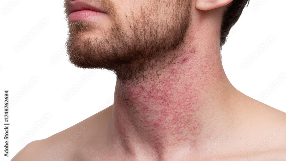 Obraz premium PNG of Close-up of a male with fair skin showing skin irritation on the neck and beard area.