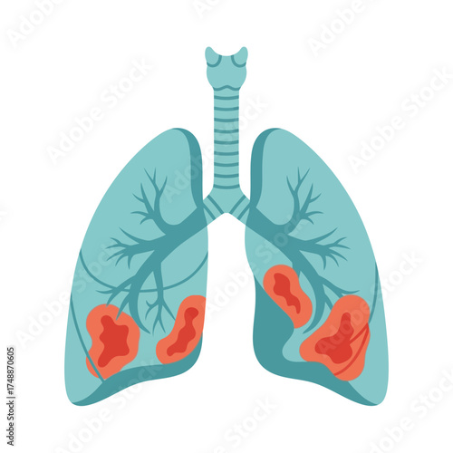 Infected human lungs showing inflammation and disease