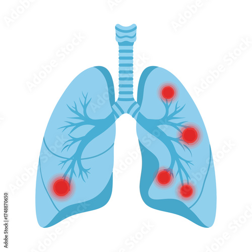 Human lungs showing healthy and inflamed areas
