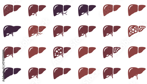 Liver vector icon set showing healthy, fatty, and cirrhosis liver disease stages. Human internal organ anatomy for medical illustration, hepatology infographic, isolated on white.