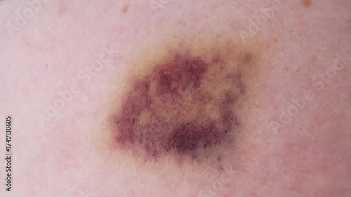 The bruise on skin close-up view. Various shades of healing process. Dark purple and yellow bruising colors on white skin. The violence concept. The consequences of injury. High quality 4k footage.