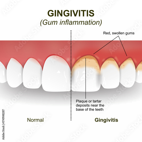 Gingivitis - Gum inflammation Flashcard Illustration