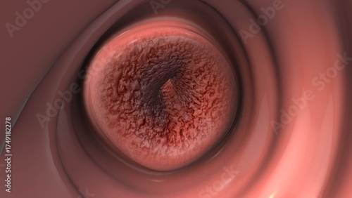 HPV Viral Infection Progression Inside the Female Uterus
