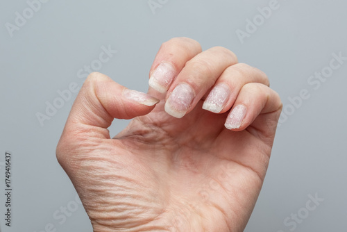 Fotografie Damaged natural fingernails after gel polish removal on human hand close-up