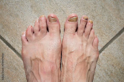 Micose com infeção fúngica em ambas as unhas dos pés.