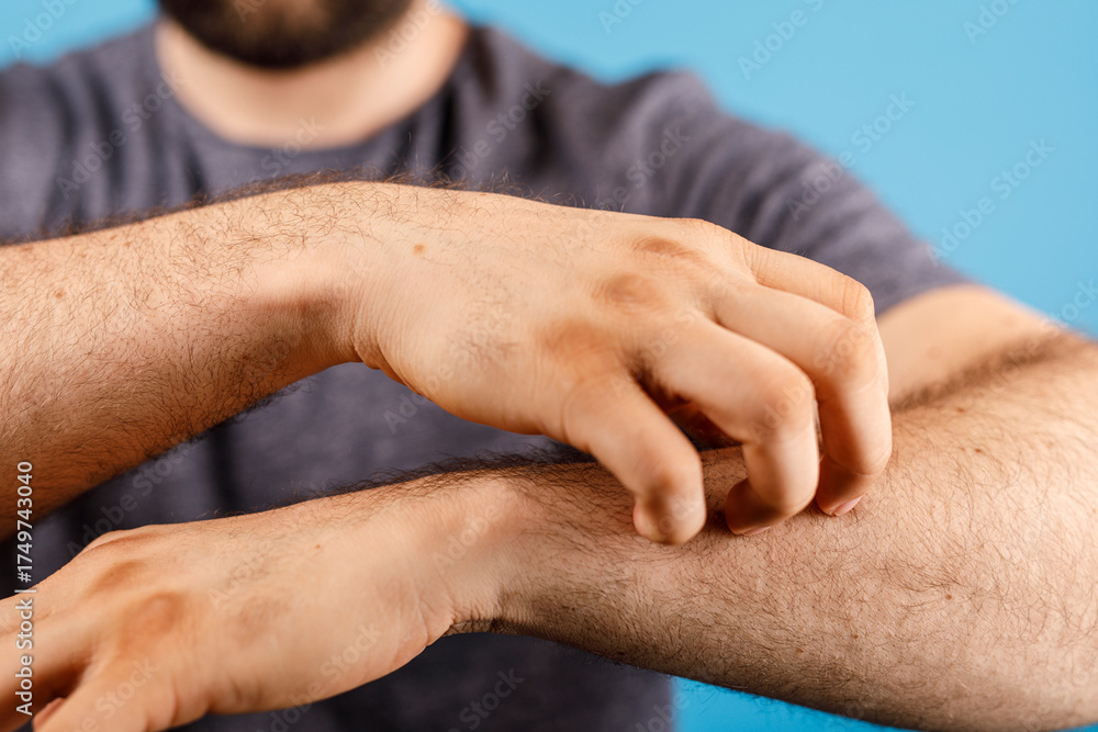 Fototapeta premium A man scratching his arm, depicting skin irritation, allergy, and discomfort. Perfect for healthcare, dermatology, and allergy-related topics.