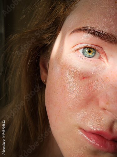 Quadro su tela Close-up of oily skin with cream, freckles, blue eye and a burst capillary