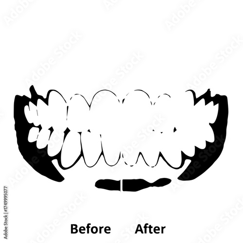 Black and White Silhouette of a Set of Human Teeth, Before and After.