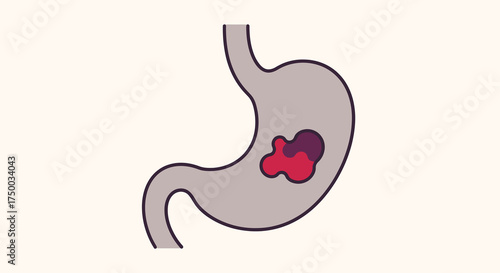 Stomach cancer illustration on a white background.