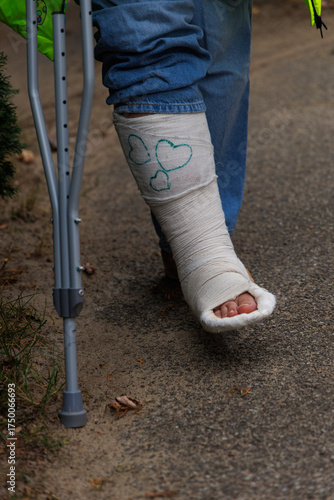 leg in a cast painted with hearts and crutches