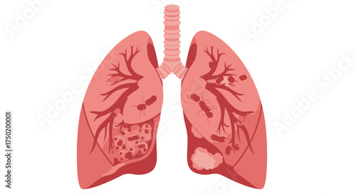 Detailed lung illustration showing infection, perfect for medical education materials, healthcare presentations, and awareness campaigns about respiratory diseases