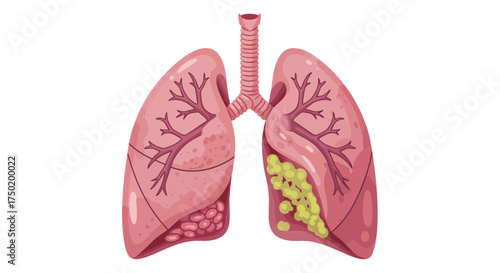 Detailed lung illustration showing respiratory health condition, perfect for medical education, healthcare campaigns and public health awareness initiatives
