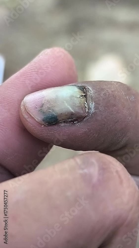 a detached fingernail