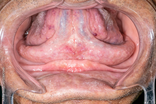 An elder dentistry patient case open mouth, lips retracted with a plastic cheek retractor. Close up front view showing a retracted tongue, and an edentulous and atrophied anterior mandibular arch.
