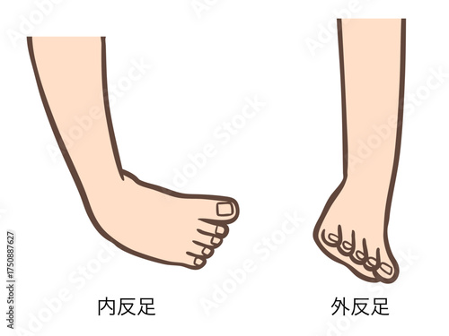 足部の変形、内反足と外反足のイラスト01