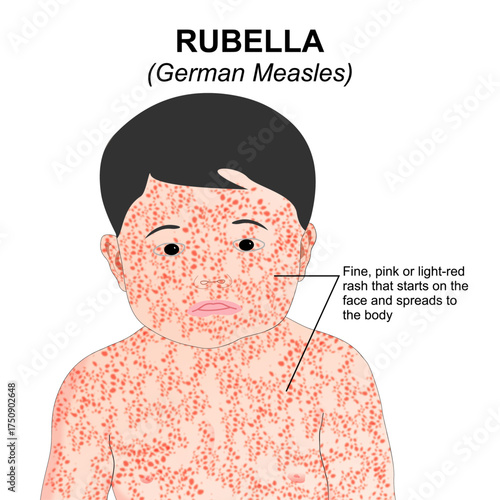 Rubella (German Measles) Flashcard Illustration