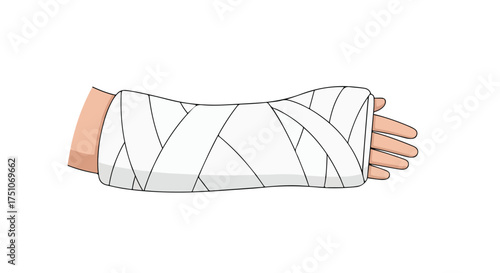 Cartoon depiction of a fractured arm encased in a white orthopedic cast for support and recovery illustrating medical assistance and injury